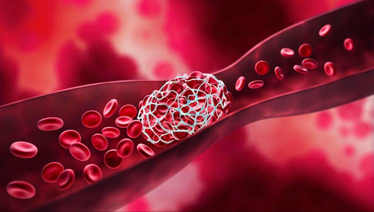 blood clot blocking an artery